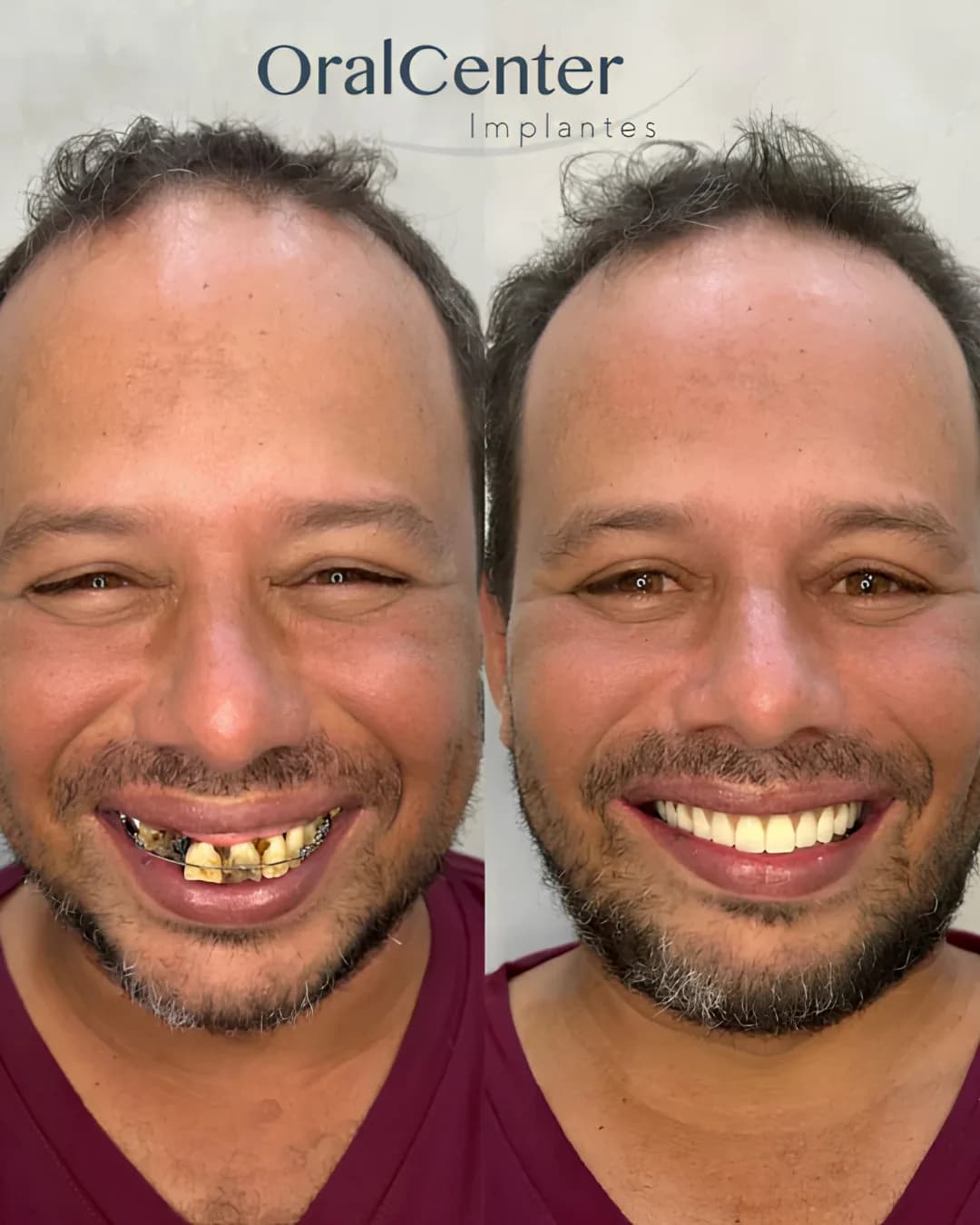 Antes e depois do sorriso de um paciente reabilitado na Oral Center