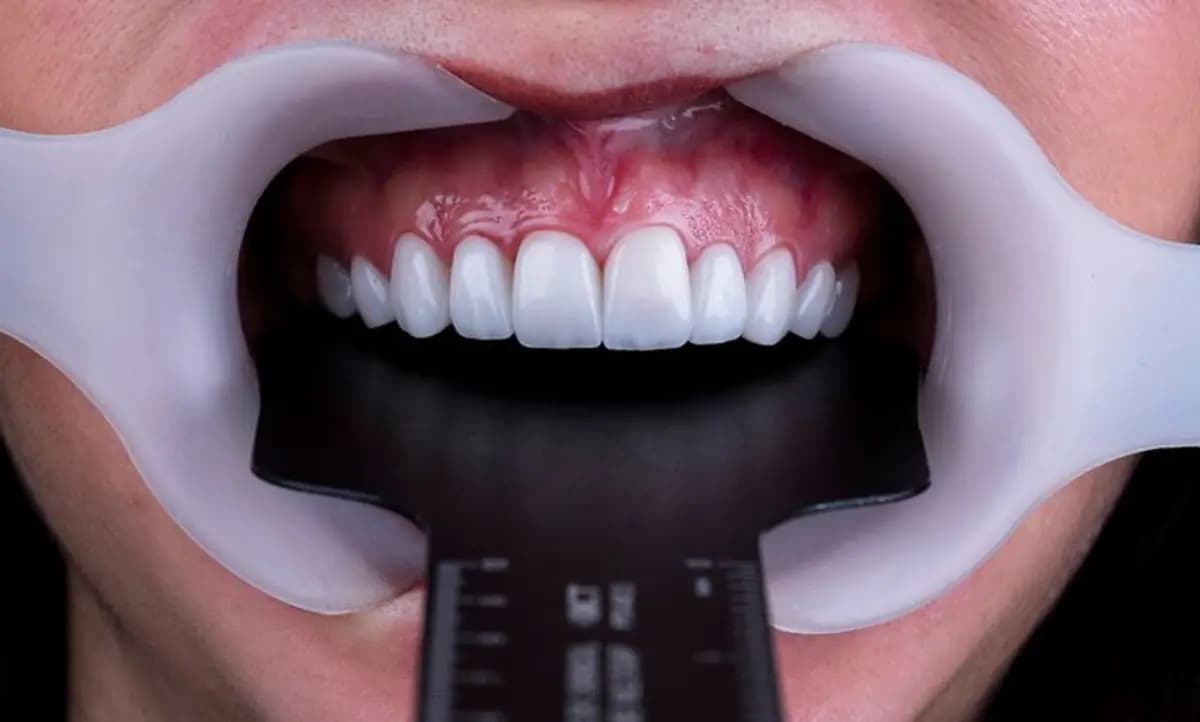 Close de uma arcada dentária reabilitada